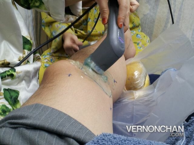 MCL Injury